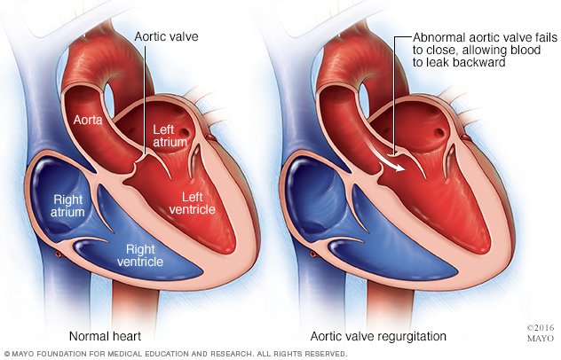 Aortic Valve Disease Disease Reference Guide